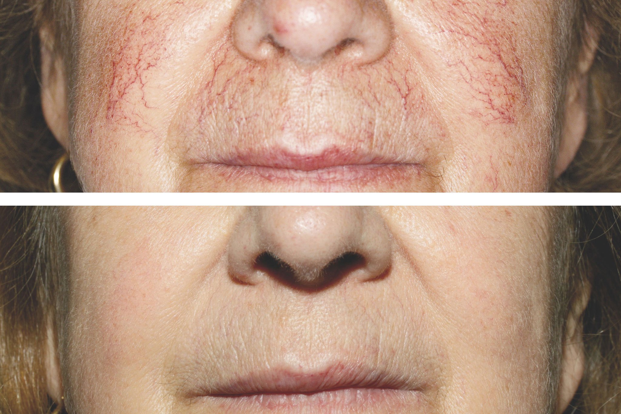 antes-y-despues-mejillas-clinica-estetica-castelblanque antes-y-despues-mejillas-clinica-estetica-castelblanque